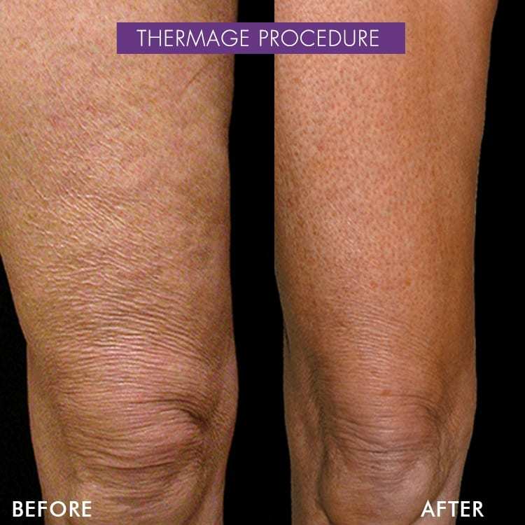 thermage before after knees