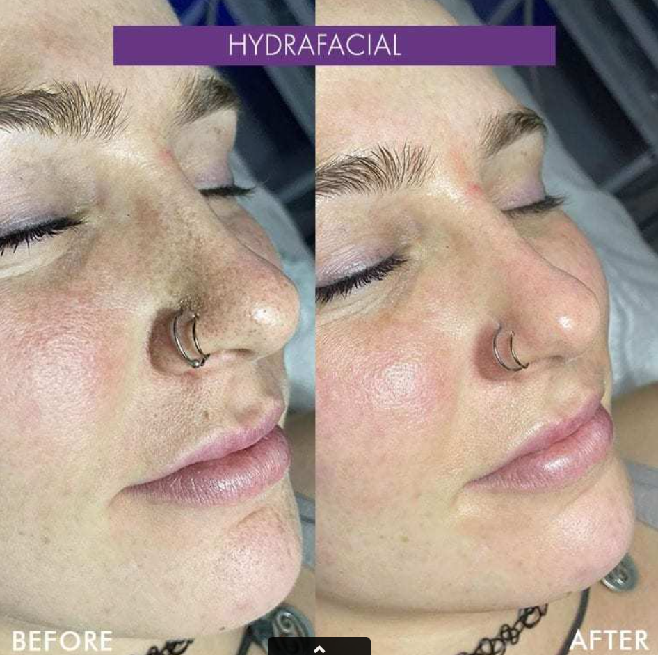 Nashville Hydrafacial