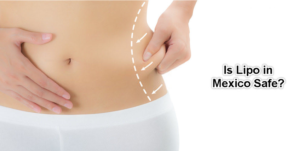 is liposuction in mexico safe