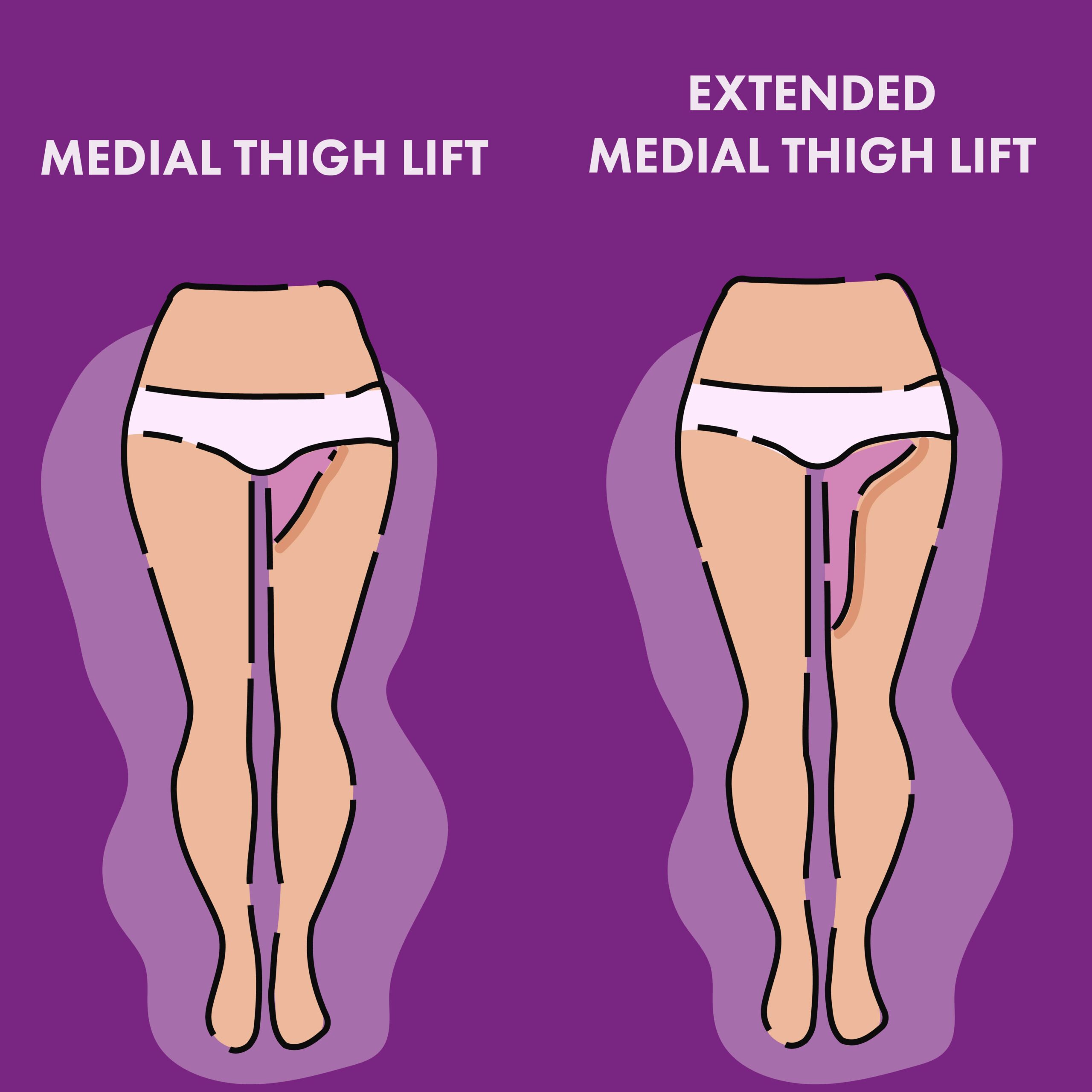 thigh lift surgery in Mexico