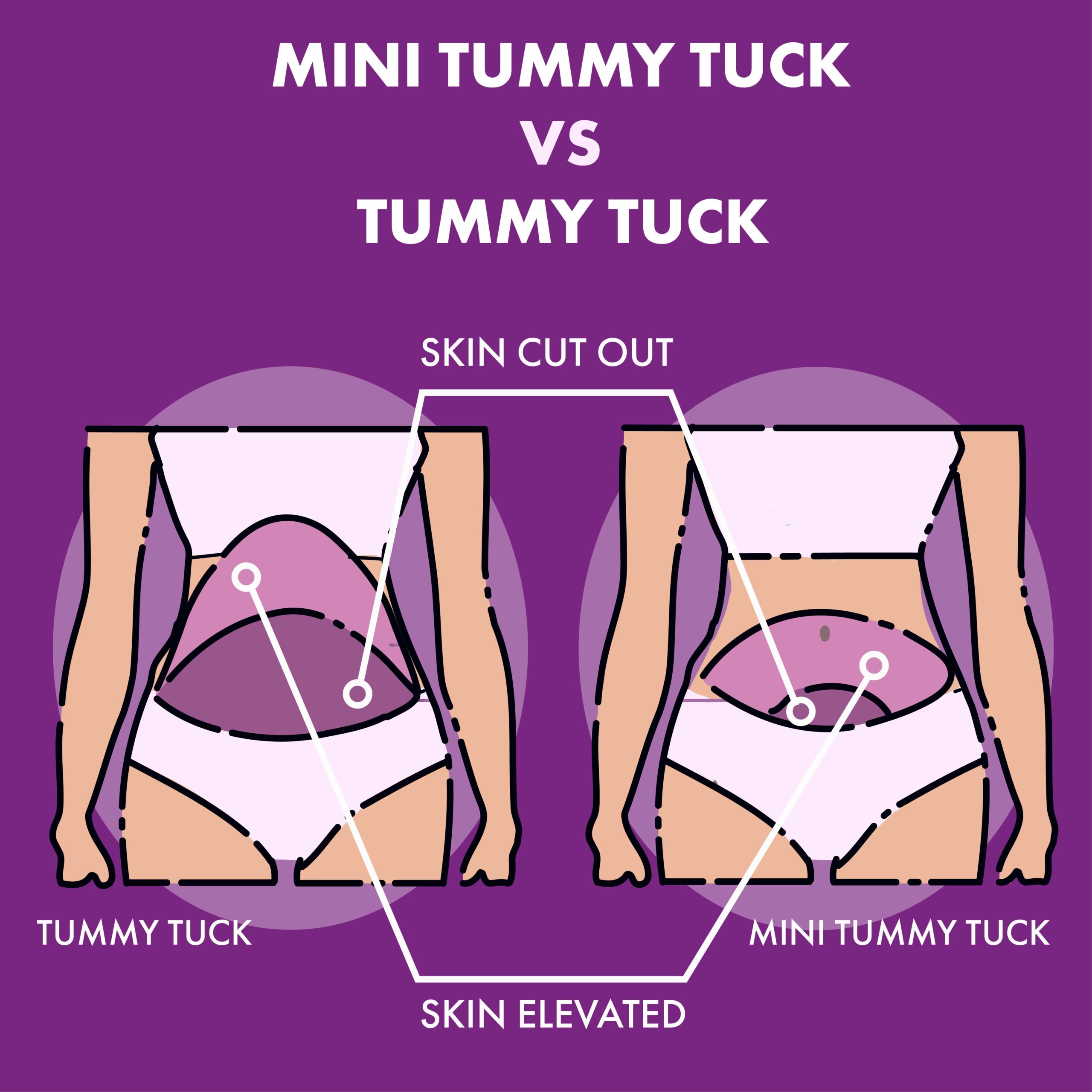 mini tummy tuck vs tummy tuck