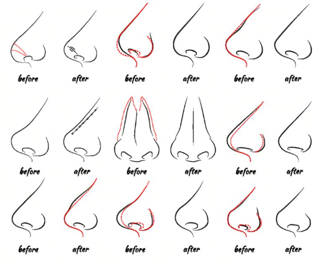 Rhinoplasty 101 All About Nose Jobs VIDA Wellness and Beauty