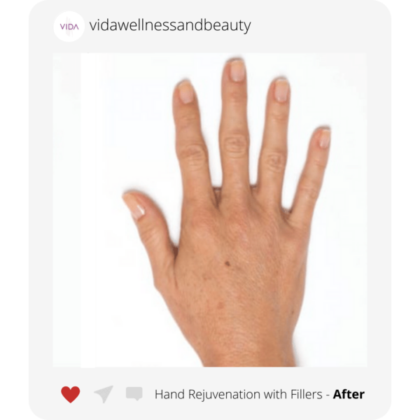 Hand rejuvenation and what you need to know VIDA Wellness and Beauty