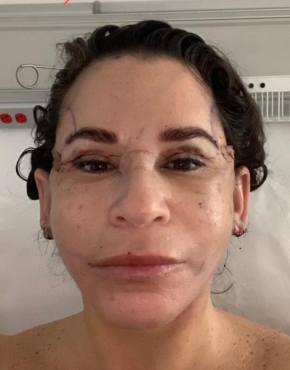 Recovery After Your Facelift A 30Day Guide VIDA Wellness and Beauty