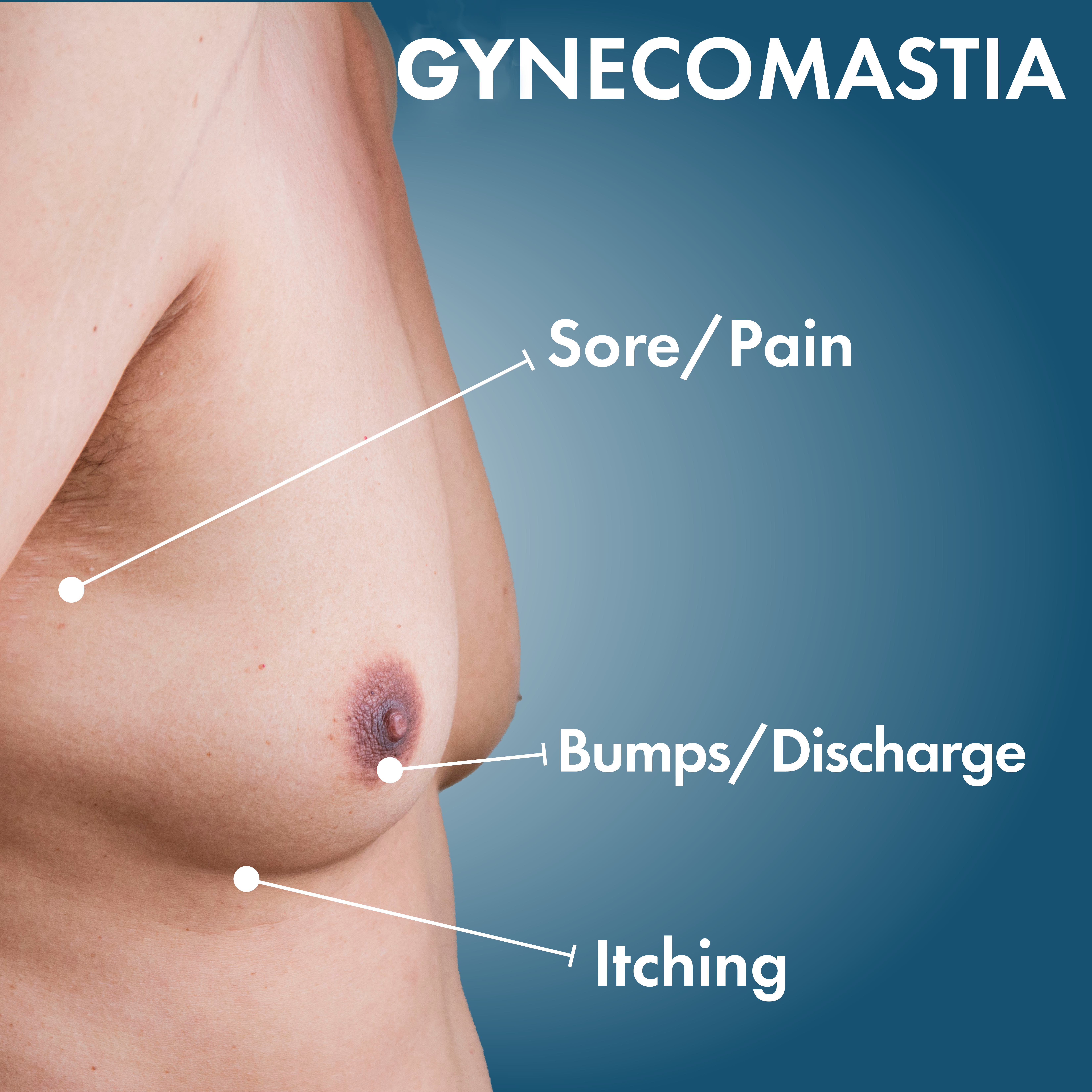 A Complete Guide to Gynecomastia