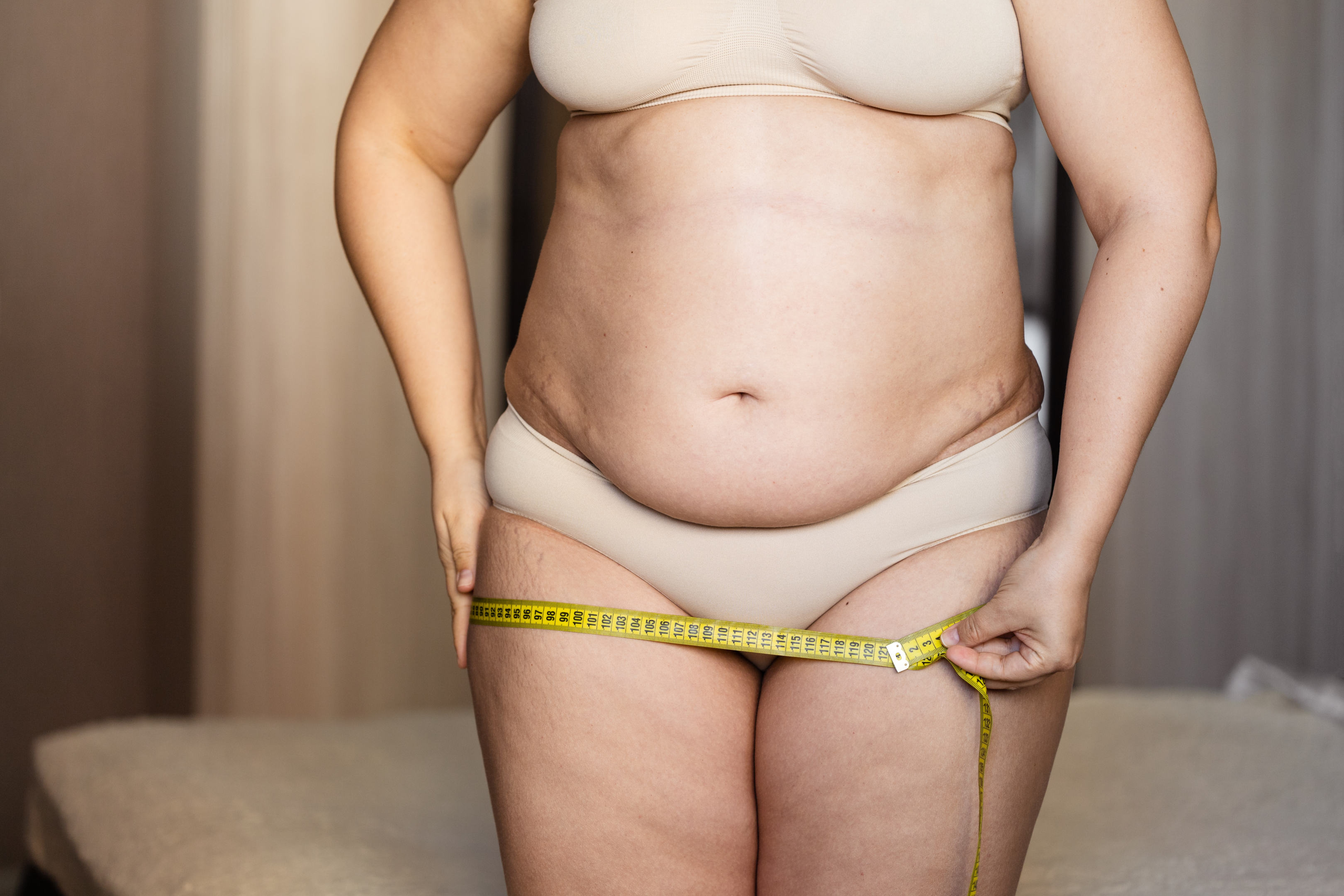 BMI of 40 or higher for qualify for a gastric sleeve procedure