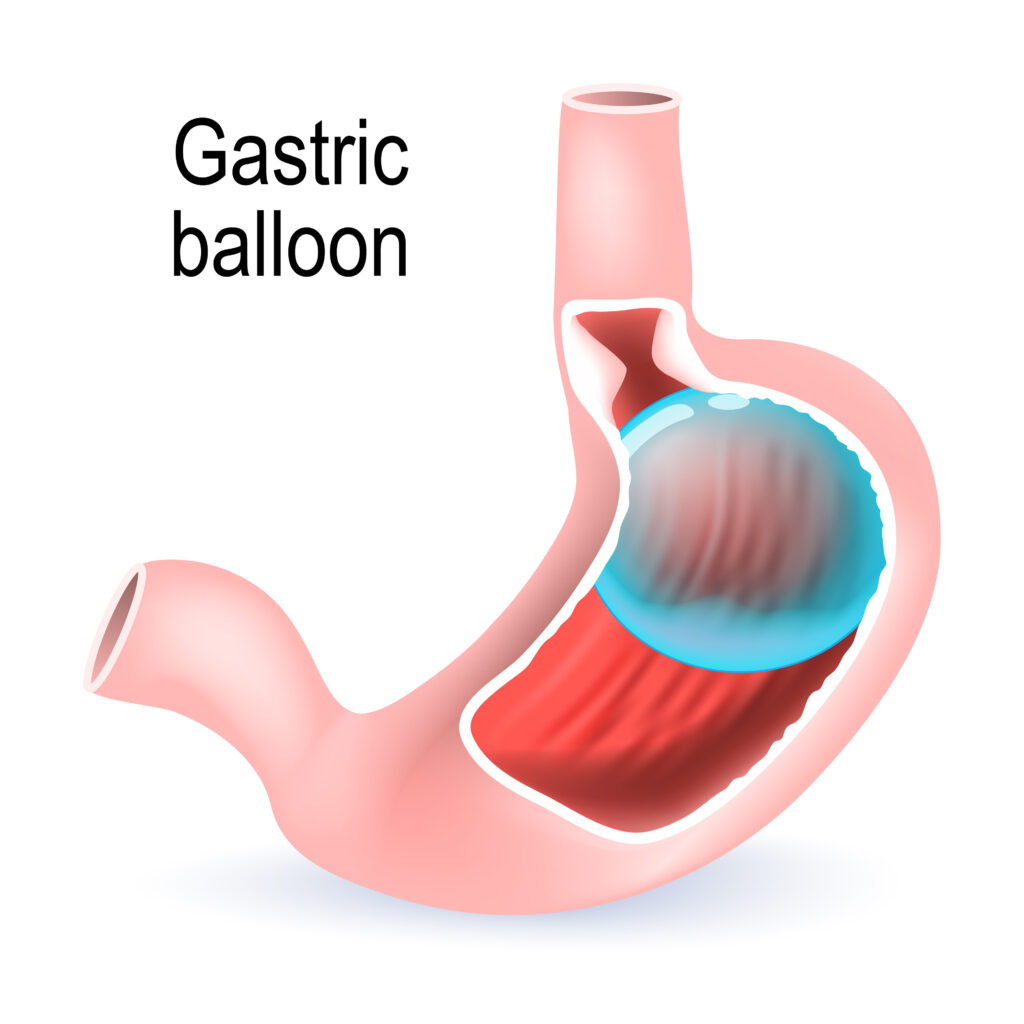 Simulation of what gastric balloon surgery looks like
