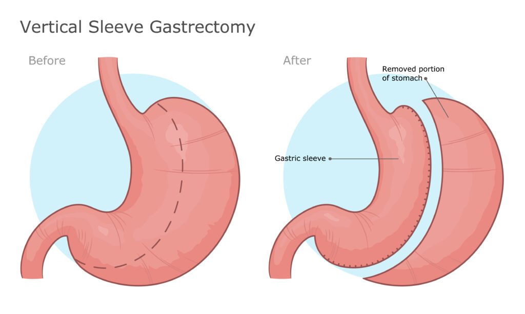 Gastric sleeve surgery before and after surgery