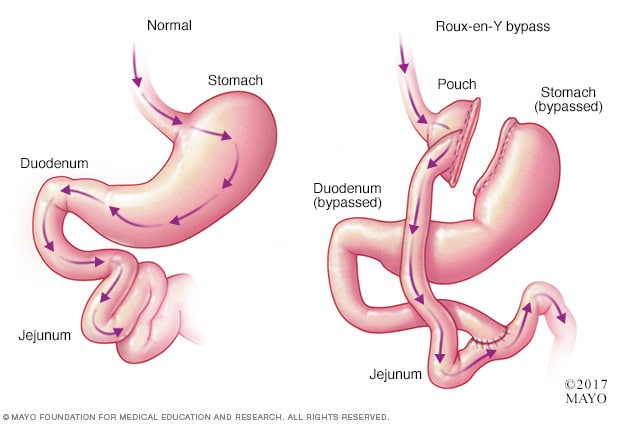 Gastric bypass surgery - Mayo Clinic