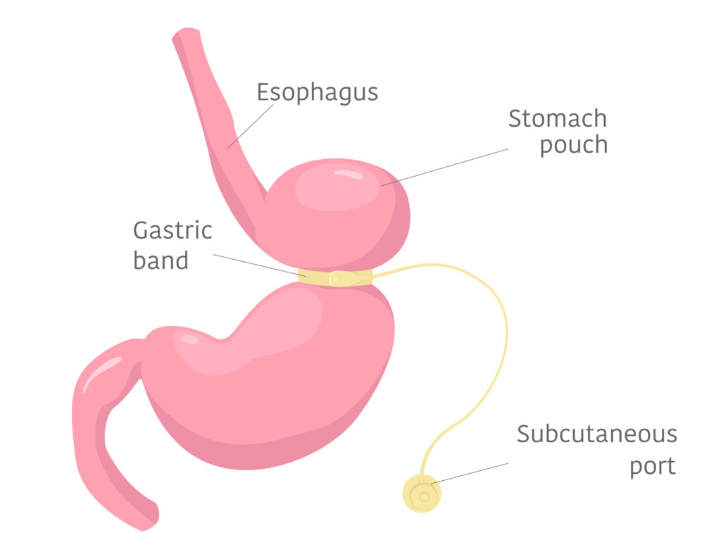 Overview of lap band surgery in people with obesity