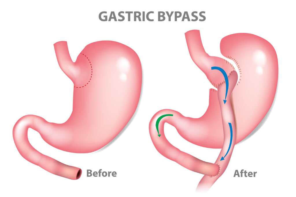 Before and after what a stomach looks like after gastric bypass.