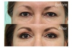 Female Blepharoplasty