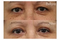 Female Blepharoplasty