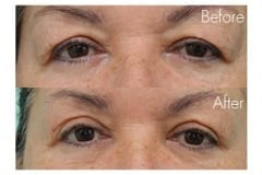 Female Blepharoplasty