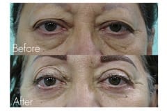 Female Blepharoplasty