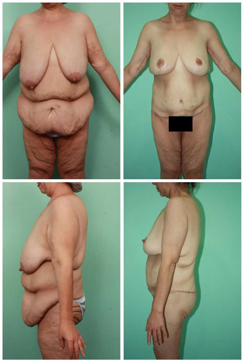 Before and after a Body lift surgery for women. br/Time elapsed: 4 hrs br/A...