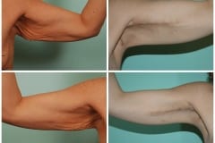 Arm Lift Surgery