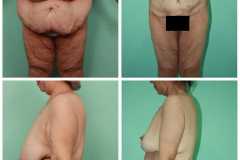 Female Body Lift  Surgery