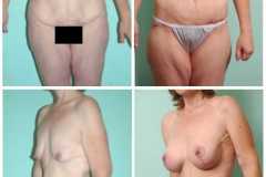Female Body Lift  Surgery