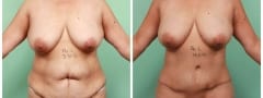 Female Abdominoplasty Surgery