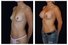 Breast Augmentation Surgery