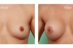 Breast Augmentation Surgery