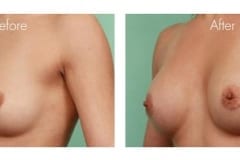 Breast Augmentation Surgery