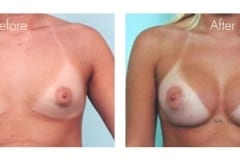 Breast Augmentation Surgery