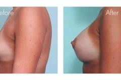 Breast Augmentation Surgery