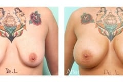 Breast Augmentation Surgery