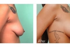 Breast Augmentation Surgery