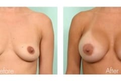 Breast Augmentation Surgery