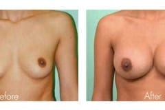 Breast Augmentation Surgery