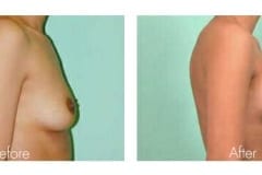 Breast Augmentation Surgery