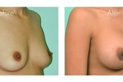 Breast Augmentation Surgery