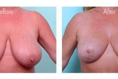 Breast Reduction surgery for women