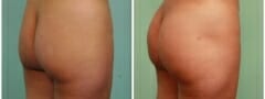 Female Brazilian Butt Lift