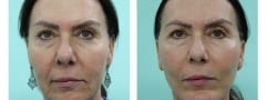 Female Chin Augmentation Surgery