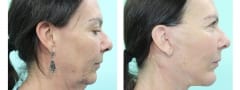 Female Chin Augmentation Surgery