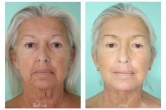 Female Facelift