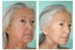 Facelift-Quiroz-Female-WFL012C