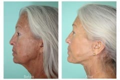 Facelift-Quiroz-Female-WFL012C