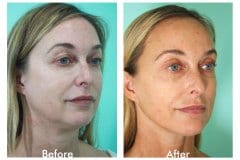 Female Facelift