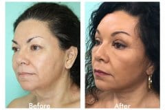 Facelift-Quiroz-Female-WFL012C