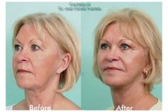 Facelift-Quiroz-Female-WFL012C