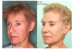 Female Facelift