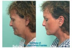 Female Facelift