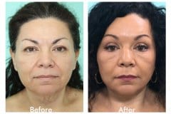 Facelift-Quiroz-Female-WFL012C