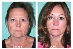 Female Facelift