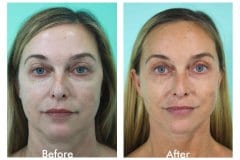 Facelift-Quiroz-Female-WFL012C